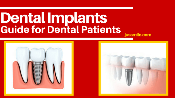 Dental Implants guide for dental patients