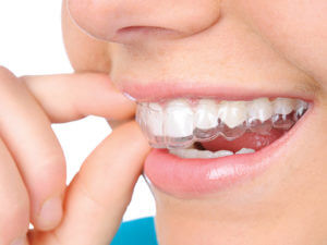 patient wearing aligners