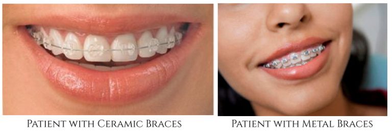 Braces | Ceramic Braces | Dental Clinic in Perambur | Jussmile