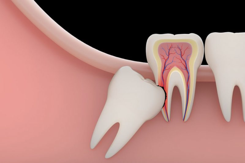 wisdom tooth removal at ramchandras jussmile dental clinic