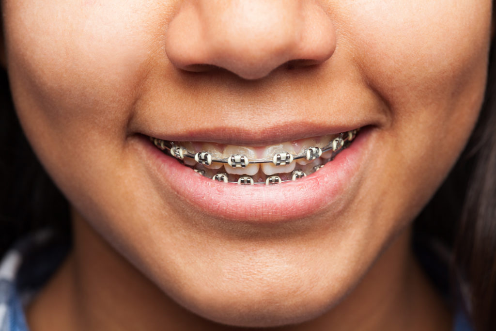 ortho braces at jussmile dental clinic