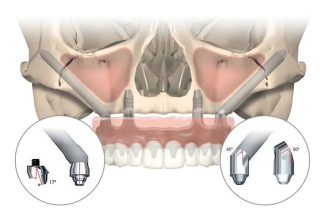 zygoma implants in chennai